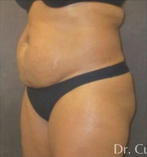 Trước: Tạo hình thành bụng (tummy tuck) & Hút mỡ vùng eo & hông — nghiêng chéo · thực hiện bởi Angelo Cuzalina, MD, DDS