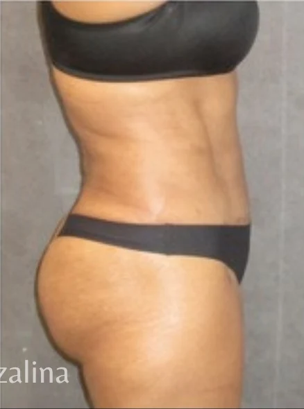 Sau: Tạo hình thành bụng (tummy tuck) & Hút mỡ vùng eo & hông — nghiêng · thực hiện bởi Angelo Cuzalina, MD, DDS