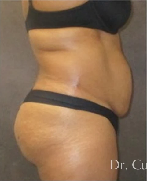 Trước: Tạo hình thành bụng (tummy tuck) & Hút mỡ vùng eo & hông — nghiêng · thực hiện bởi Angelo Cuzalina, MD, DDS