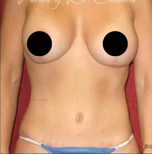 Sau: Nâng ngực đặt túi/Treo ngực, Tạo hình thành bụng (tummy tuck), Hút mỡ 360 · thực hiện bởi Angelo Cuzalina, MD, DDS