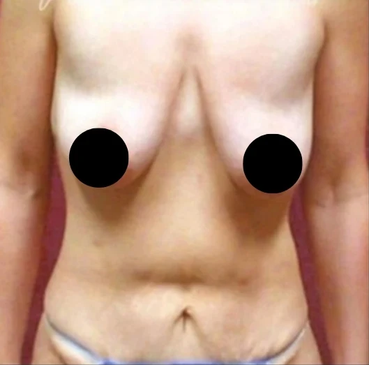 Trước: Nâng ngực đặt túi/Treo ngực, Tạo hình thành bụng (tummy tuck), Hút mỡ 360 · thực hiện bởi Angelo Cuzalina, MD, DDS