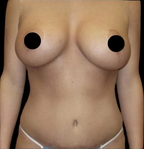 Sau: Nâng ngực đặt túi/Treo ngực, Tạo hình thành bụng (tummy tuck), Hút mỡ 360 · thực hiện bởi Angelo Cuzalina, MD, DDS