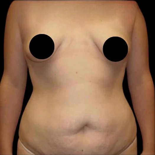 Trước: Nâng ngực đặt túi/Treo ngực, Tạo hình thành bụng (tummy tuck), Hút mỡ 360 · thực hiện bởi Angelo Cuzalina, MD, DDS