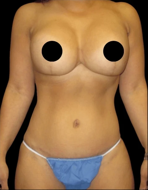 Sau: Nâng ngực đặt túi/Treo ngực, Tạo hình thành bụng (tummy tuck), Hút mỡ 360 · thực hiện bởi Angelo Cuzalina, MD, DDS