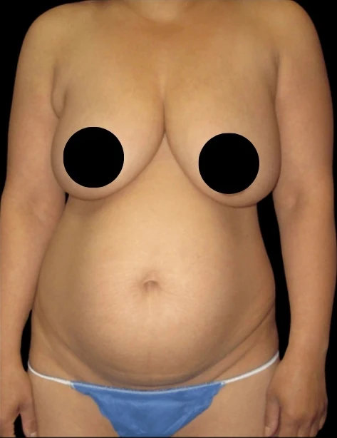 Trước: Nâng ngực đặt túi/Treo ngực, Tạo hình thành bụng (tummy tuck), Hút mỡ 360 · thực hiện bởi Angelo Cuzalina, MD, DDS