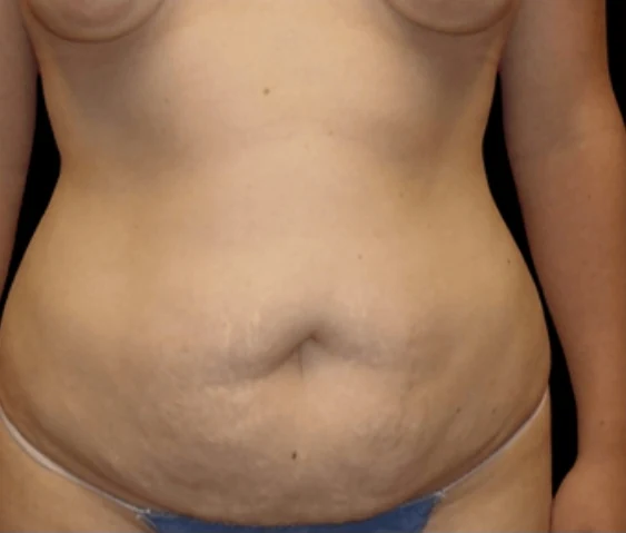 Trước: Treo ngực kết hợp đặt túi, Tạo hình thành bụng (tummy tuck), & Hút mỡ 360 · thực hiện bởi Angelo Cuzalina, MD, DDS