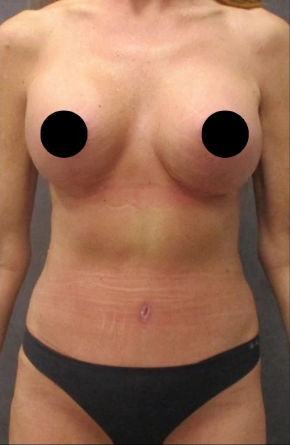 Sau: Nâng ngực đặt túi/Treo ngực, Tạo hình thành bụng (tummy tuck), Hút mỡ 360 · thực hiện bởi Angelo Cuzalina, MD, DDS