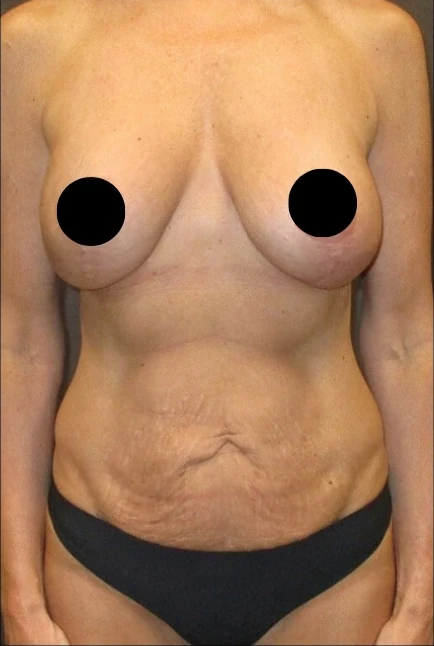 Trước: Nâng ngực đặt túi/Treo ngực, Tạo hình thành bụng (tummy tuck), Hút mỡ 360 · thực hiện bởi Angelo Cuzalina, MD, DDS