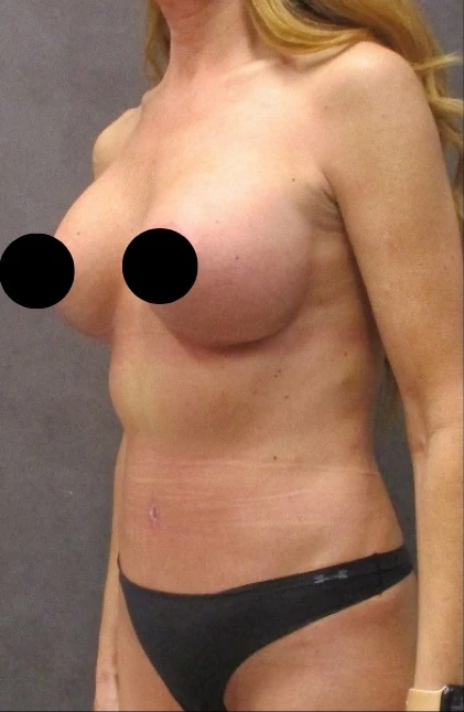 Sau: Nâng ngực đặt túi/Treo ngực, Tạo hình thành bụng (tummy tuck), Hút mỡ 360 · thực hiện bởi Angelo Cuzalina, MD, DDS