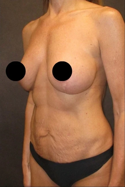Trước: Nâng ngực đặt túi/Treo ngực, Tạo hình thành bụng (tummy tuck), Hút mỡ 360 · thực hiện bởi Angelo Cuzalina, MD, DDS