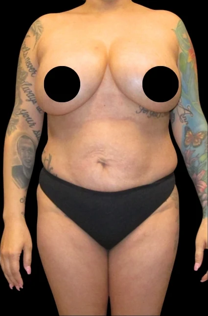 Trước: Treo ngực kết hợp đặt túi, Tạo hình thành bụng (tummy tuck), Hút mỡ 360, Nâng mông kiểu Brazil (BBL) và Hút mỡ cánh tay · thực hiện bởi Angelo Cuzalina, MD, DDS