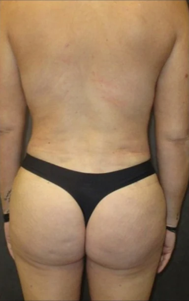 Sau: Tạo hình thành bụng (tummy tuck), Hút mỡ bụng, Nâng ngực đặt túi/Treo ngực & Nâng mông kiểu Brazil (BBL) — mặt sau · thực hiện bởi Angelo Cuzalina, MD, DDS