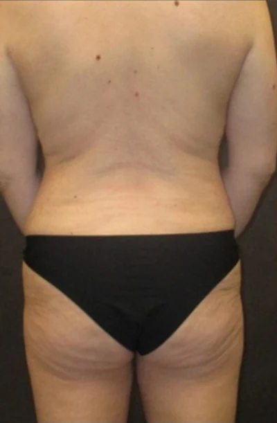Trước: Tạo hình thành bụng (tummy tuck), Hút mỡ bụng, Nâng ngực đặt túi/Treo ngực & Nâng mông kiểu Brazil (BBL) — mặt sau · thực hiện bởi Angelo Cuzalina, MD, DDS