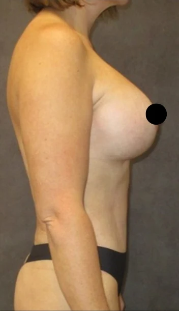 Sau: Tạo hình thành bụng (tummy tuck), Hút mỡ bụng, Nâng ngực đặt túi/Treo ngực & Nâng mông kiểu Brazil (BBL) — nghiêng · thực hiện bởi Angelo Cuzalina, MD, DDS