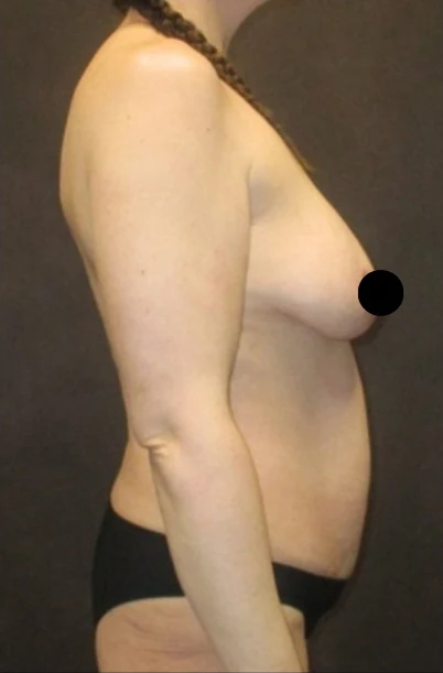 Trước: Tạo hình thành bụng (tummy tuck), Hút mỡ bụng, Nâng ngực đặt túi/Treo ngực & Nâng mông kiểu Brazil (BBL) — nghiêng · thực hiện bởi Angelo Cuzalina, MD, DDS
