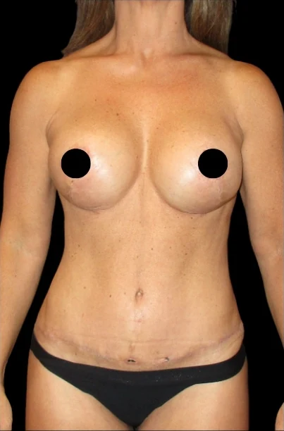 Sau: Nâng ngực đặt túi/Treo ngực, Tạo hình thành bụng (tummy tuck), Hút mỡ 360 — mặt trước · thực hiện bởi Angelo Cuzalina, MD, DDS