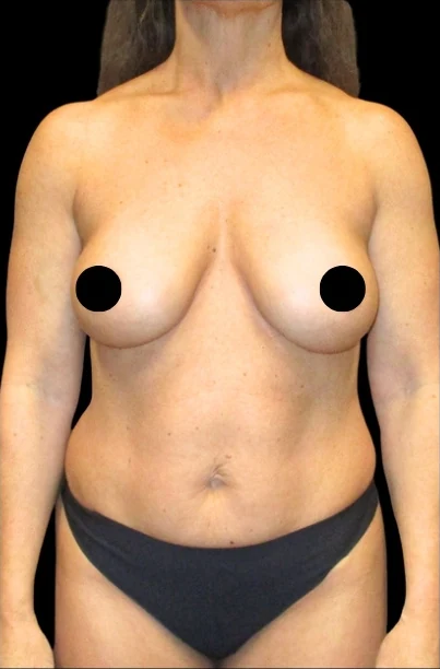Trước: Nâng ngực đặt túi/Treo ngực, Tạo hình thành bụng (tummy tuck), Hút mỡ 360 — mặt trước · thực hiện bởi Angelo Cuzalina, MD, DDS