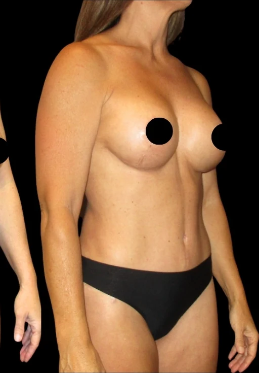 Sau: Nâng ngực đặt túi/Treo ngực, Tạo hình thành bụng (tummy tuck), Hút mỡ 360 — nghiêng chéo · thực hiện bởi Angelo Cuzalina, MD, DDS