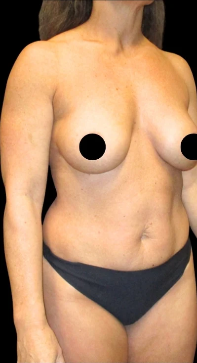 Trước: Nâng ngực đặt túi/Treo ngực, Tạo hình thành bụng (tummy tuck), Hút mỡ 360 — nghiêng chéo · thực hiện bởi Angelo Cuzalina, MD, DDS