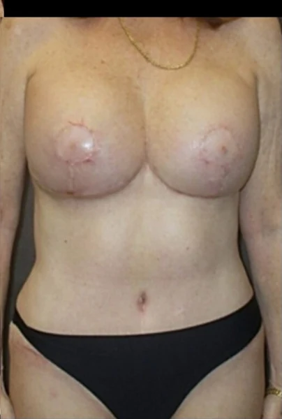 Sau: Nâng ngực đặt túi/Treo ngực & Tạo hình thành bụng (tummy tuck) — thân trước · thực hiện bởi Angelo Cuzalina, MD, DDS