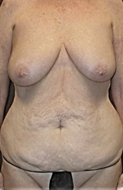 Trước: Nâng ngực đặt túi/Treo ngực & Tạo hình thành bụng (tummy tuck) — thân trước · thực hiện bởi Angelo Cuzalina, MD, DDS