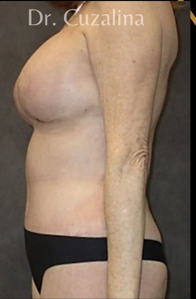 Sau: Nâng ngực đặt túi/Treo ngực & Tạo hình thành bụng (tummy tuck) — nghiêng · thực hiện bởi Angelo Cuzalina, MD, DDS