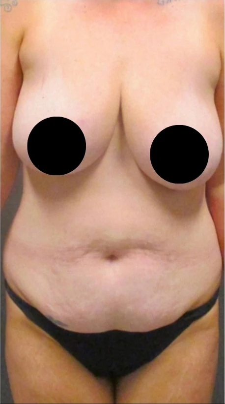 Trước: Mommy Makeover · thực hiện bởi Angelo Cuzalina, MD, DDS