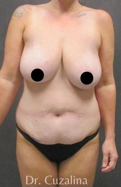 Trước: Mommy Makeover — mặt trước · thực hiện bởi Angelo Cuzalina, MD, DDS