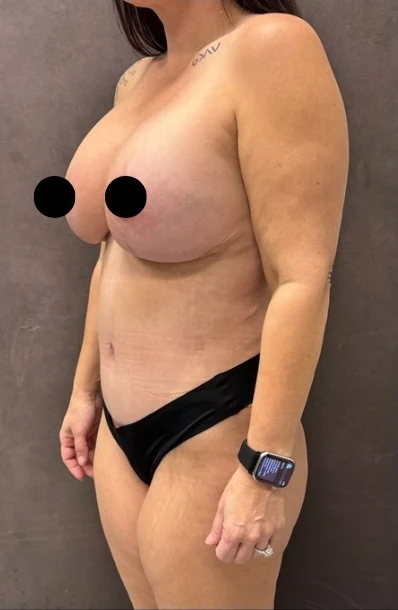 Sau: Mommy Makeover — nghiêng chéo · thực hiện bởi Angelo Cuzalina, MD, DDS
