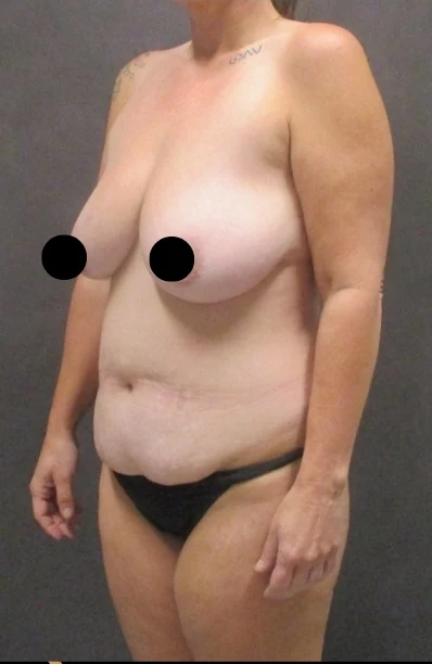 Trước: Mommy Makeover — nghiêng chéo · thực hiện bởi Angelo Cuzalina, MD, DDS