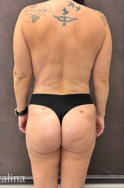 Sau: Mommy Makeover · thực hiện bởi Angelo Cuzalina, MD, DDS