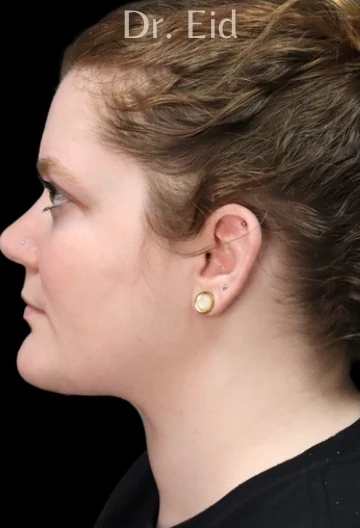 Sau: Tạo hình vùng dưới cằm (submentoplasty) — nghiêng · thực hiện bởi Rola Eid, DO, FACOS, FACS