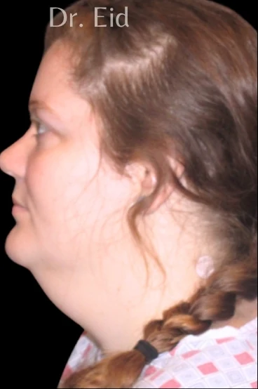 Trước: Tạo hình vùng dưới cằm (submentoplasty) — nghiêng · thực hiện bởi Rola Eid, DO, FACOS, FACS