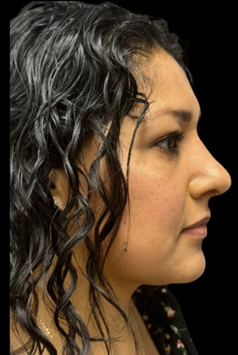 Sau: Phẫu thuật tạo hình mũi (nâng mũi) · thực hiện bởi Angelo Cuzalina, MD, DDS