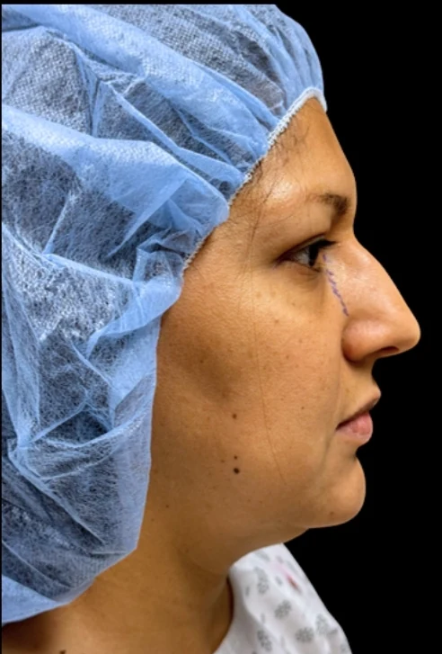 Trước: Phẫu thuật tạo hình mũi (nâng mũi) · thực hiện bởi Angelo Cuzalina, MD, DDS