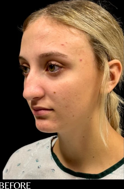 Trước: Phẫu thuật tạo hình mũi (nâng mũi) — nghiêng chéo · thực hiện bởi Angelo Cuzalina, MD, DDS
