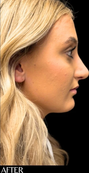 Sau: Phẫu thuật tạo hình mũi (nâng mũi) — nghiêng · thực hiện bởi Angelo Cuzalina, MD, DDS