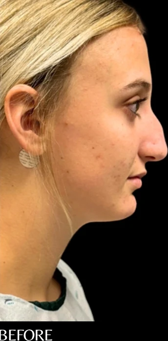 Trước: Phẫu thuật tạo hình mũi (nâng mũi) — nghiêng · thực hiện bởi Angelo Cuzalina, MD, DDS