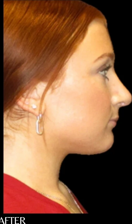 Sau: Phẫu thuật tạo hình mũi (nâng mũi) — nghiêng · thực hiện bởi Angelo Cuzalina, MD, DDS
