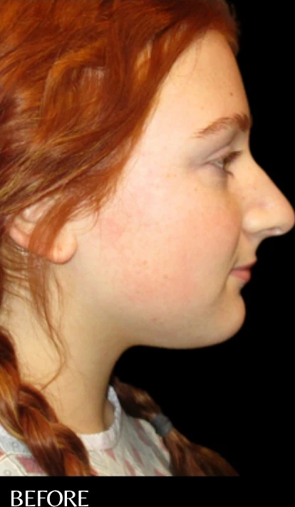 Trước: Phẫu thuật tạo hình mũi (nâng mũi) — nghiêng · thực hiện bởi Angelo Cuzalina, MD, DDS