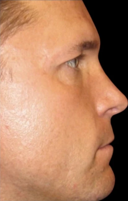 Sau: Phẫu thuật tạo hình mũi (nâng mũi) · thực hiện bởi Angelo Cuzalina, MD, DDS