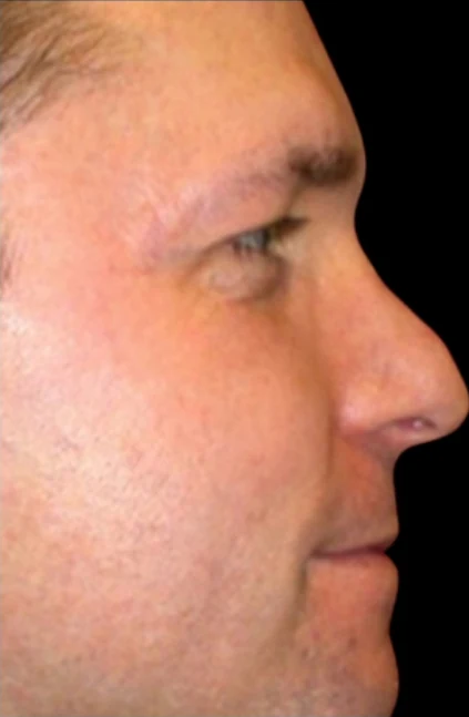 Trước: Phẫu thuật tạo hình mũi (nâng mũi) · thực hiện bởi Angelo Cuzalina, MD, DDS