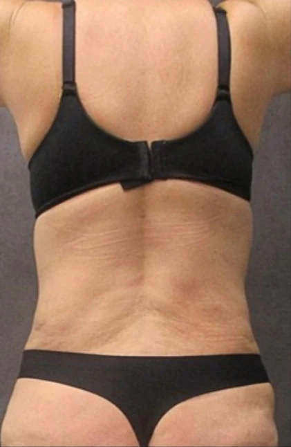 Sau: Tạo hình thành bụng (tummy tuck) & Hút mỡ 360 vùng eo và hông — mặt sau · thực hiện bởi Angelo Cuzalina, MD, DDS