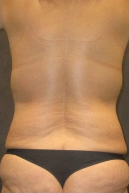 Trước: Tạo hình thành bụng (tummy tuck) & Hút mỡ 360 vùng eo và hông — mặt sau · thực hiện bởi Angelo Cuzalina, MD, DDS