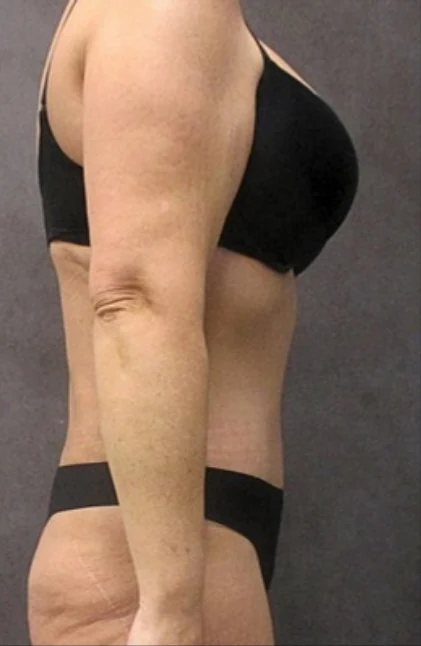Sau: Tạo hình thành bụng (tummy tuck) & Hút mỡ 360 vùng eo và hông — nghiêng · thực hiện bởi Angelo Cuzalina, MD, DDS