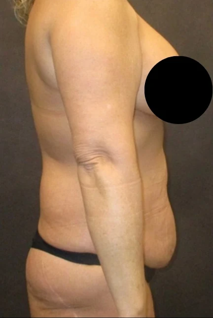 Trước: Tạo hình thành bụng (tummy tuck) & Hút mỡ 360 vùng eo và hông — nghiêng · thực hiện bởi Angelo Cuzalina, MD, DDS