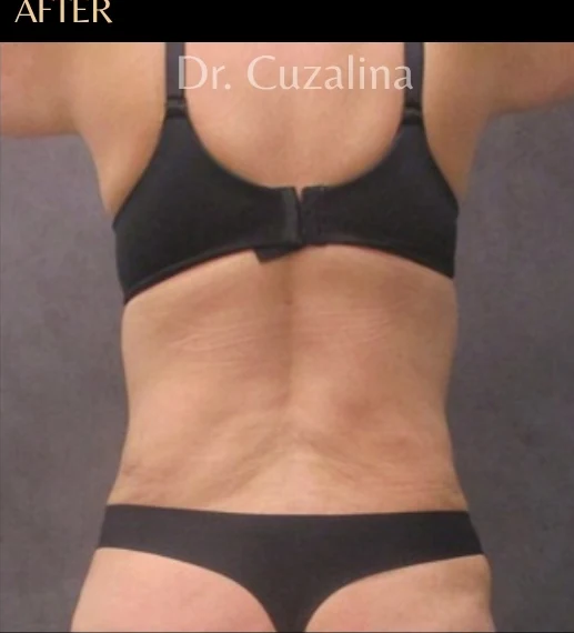 Sau: Tạo hình thành bụng (tummy tuck) & Hút mỡ 360 — mặt sau · thực hiện bởi Angelo Cuzalina, MD, DDS