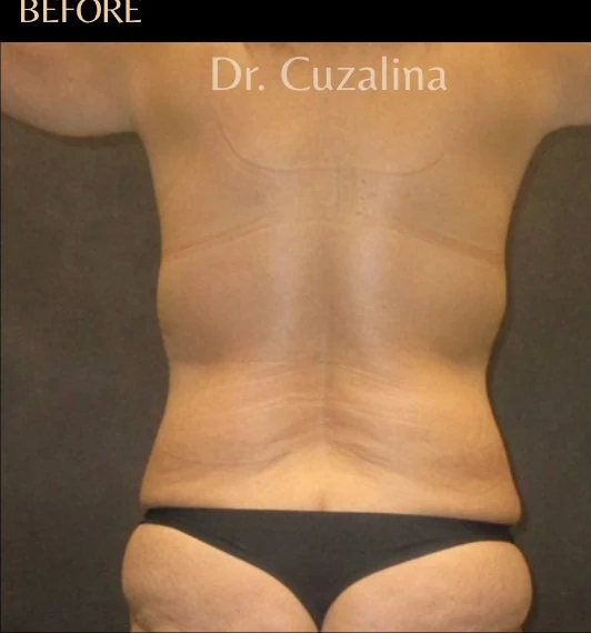 Trước: Tạo hình thành bụng (tummy tuck) & Hút mỡ 360 — mặt sau · thực hiện bởi Angelo Cuzalina, MD, DDS