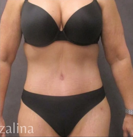 Sau: Tạo hình thành bụng (tummy tuck) & Hút mỡ 360 — mặt trước · thực hiện bởi Angelo Cuzalina, MD, DDS