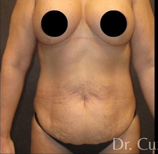 Trước: Tạo hình thành bụng (tummy tuck) & Hút mỡ 360 — mặt trước · thực hiện bởi Angelo Cuzalina, MD, DDS